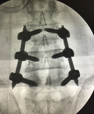 Posterior Instrumentation and Fusion (PSF)